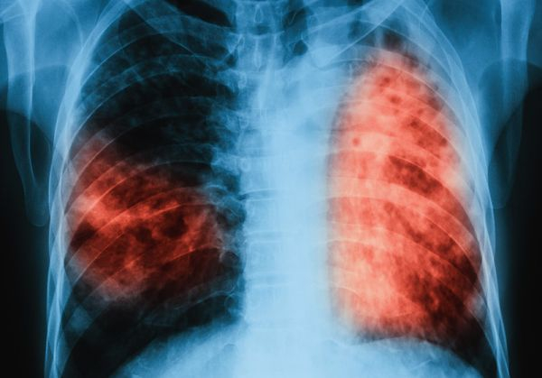 Пътят на туберкулозата: Ето кой, кога и как я е разпространил 
