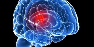 Лекари алармират: Това са симптомите за тумор в мозъка, не се самолекувайте!