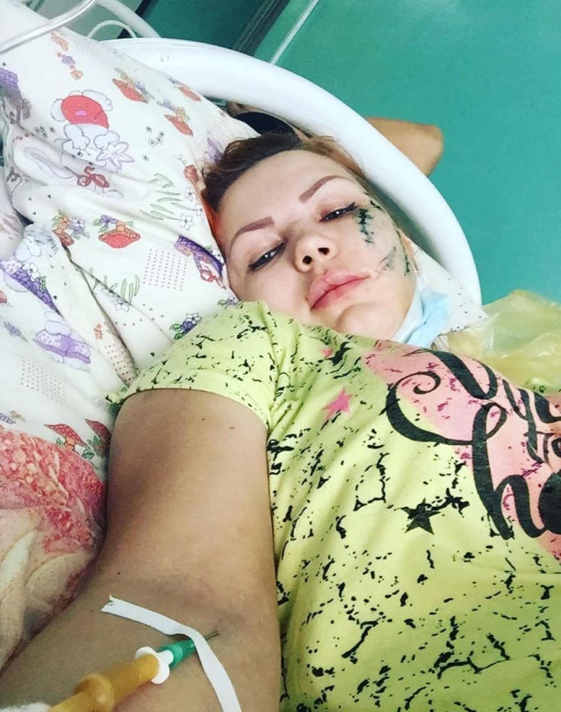 Млада жена отиде да се забавлява в караоке бар, но завърши вечерта в болница с обезобразено лице (СНИМКИ 18+)