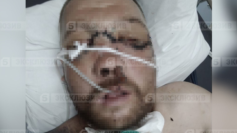 Потресаващи СНИМКИ 18+! Хирурзи пришиха лицето на мъж, нарязан с мачете 