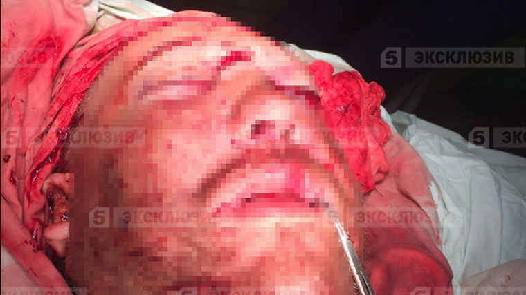 Потресаващи СНИМКИ 18+! Хирурзи пришиха лицето на мъж, нарязан с мачете 