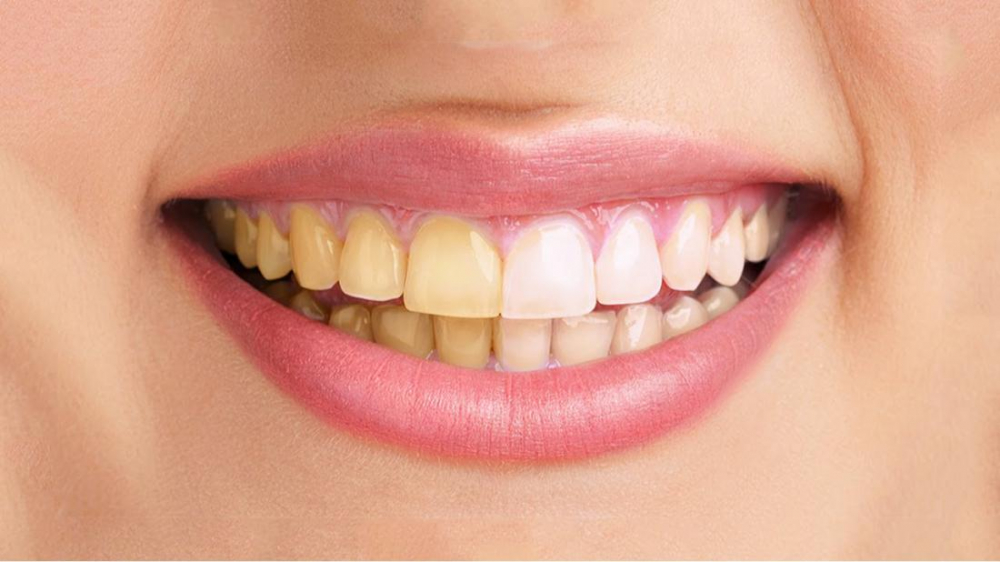 Защо зъбите пожълтяват и как да си помогнете