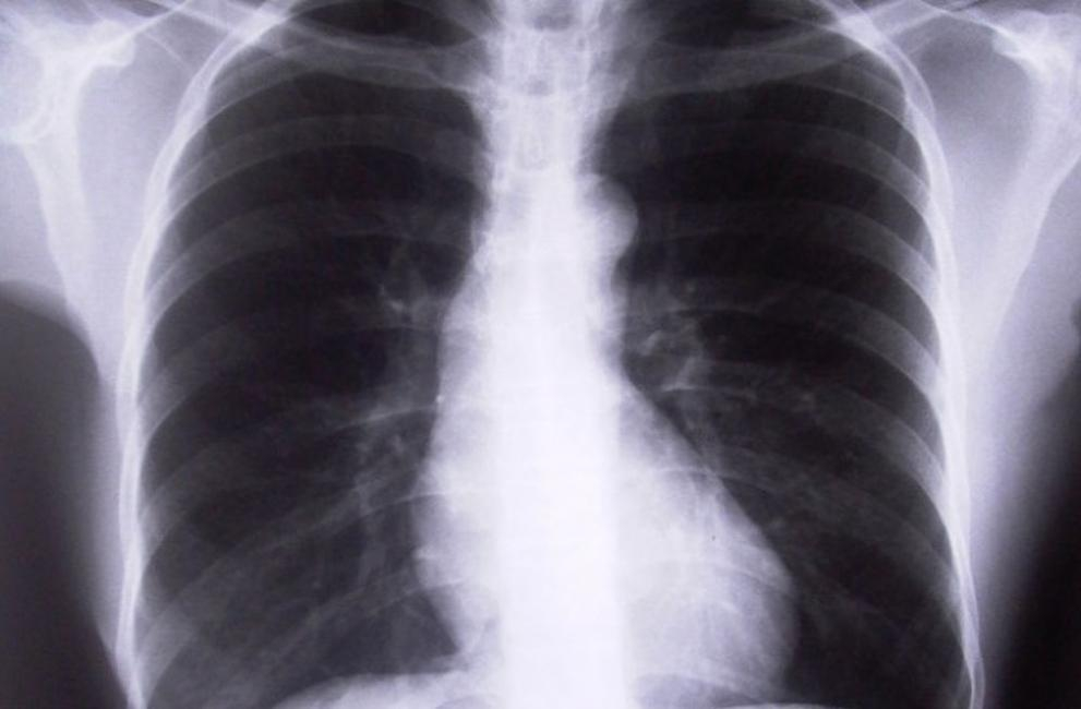 Онколози от UK алармират: Това е основен симптом на рак на белите дробове, не го подминавайте!