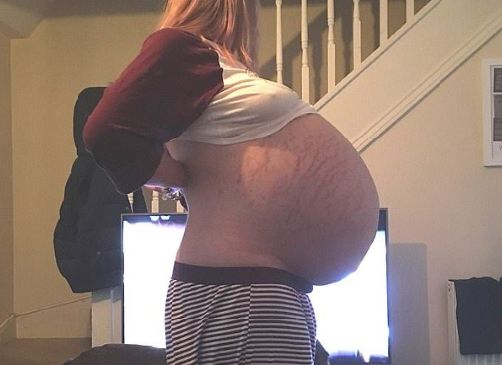 Кийли имаше огромен корем, мислеше, че е бременна, но три теста се оказаха отрицателни, а истината зловеща (ШОКИРАЩИ СНИМКИ 18+)