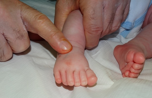 Уникална операция в Бургас на бебе с по 6 пръста на ръчичките и крачетата