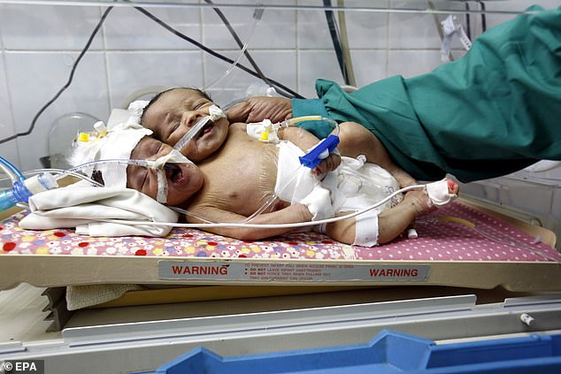 Двуглави сиамски близнаци удивиха лекарите в Йемен (СНИМКИ)