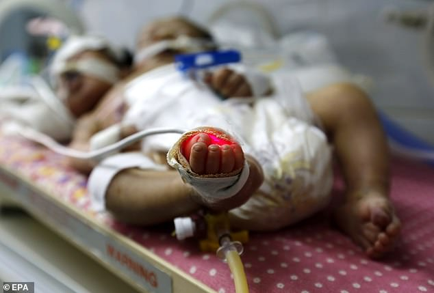 Двуглави сиамски близнаци удивиха лекарите в Йемен (СНИМКИ)
