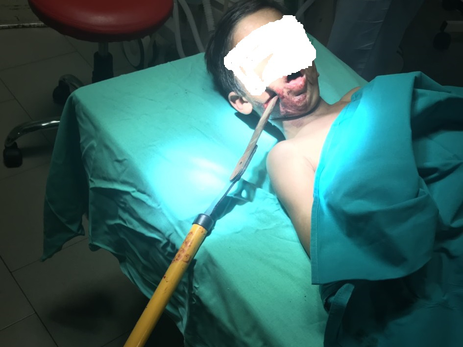 Спасиха детето със забита в лицето 70 сантиметрова ножица (СНИМКИ 18+)