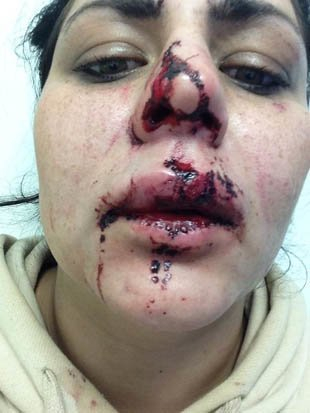 Приказна красавица, нападната от мъже на улицата, показа кървави СНИМКИ 18+ 