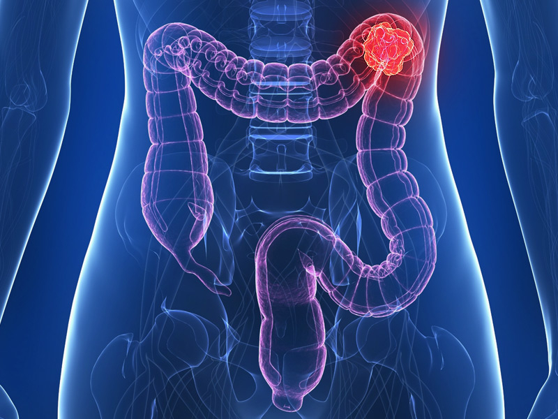 Ранни симптоми и знаци за рак на дебелото черво 