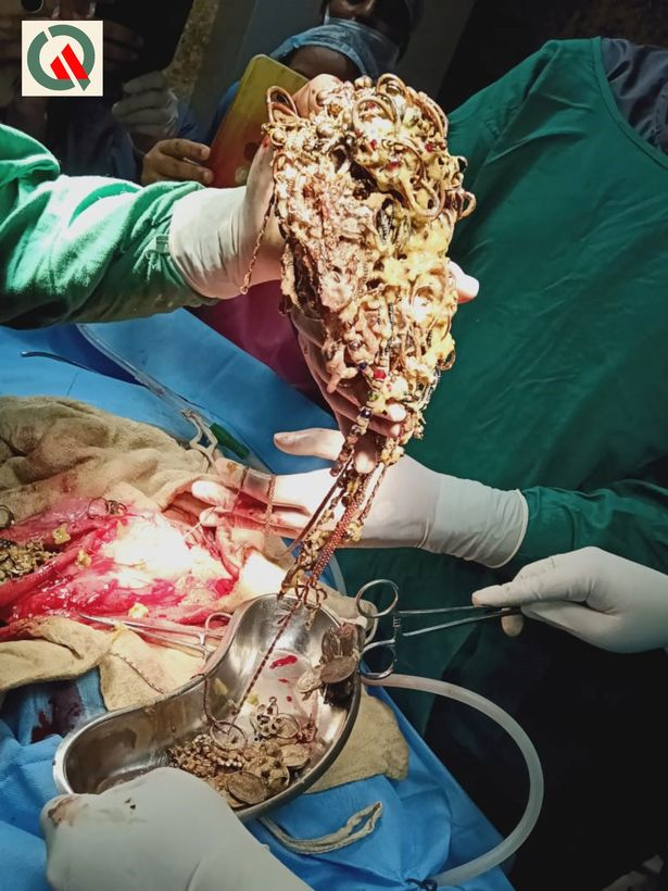 Лекари откриха истинско имане в стомаха на млада жена ВИДЕО 18+