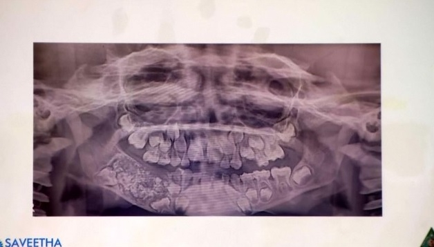 Първи случай в света: Лекари извадиха 526 зъба от устата на дете