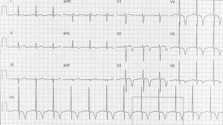 Ето как изглежда кардиограмата на човек по време на инфаркт СНИМКИ