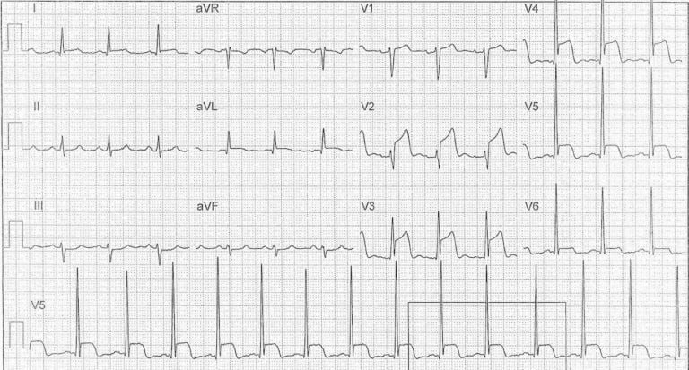 Ето как изглежда кардиограмата на човек по време на инфаркт СНИМКИ