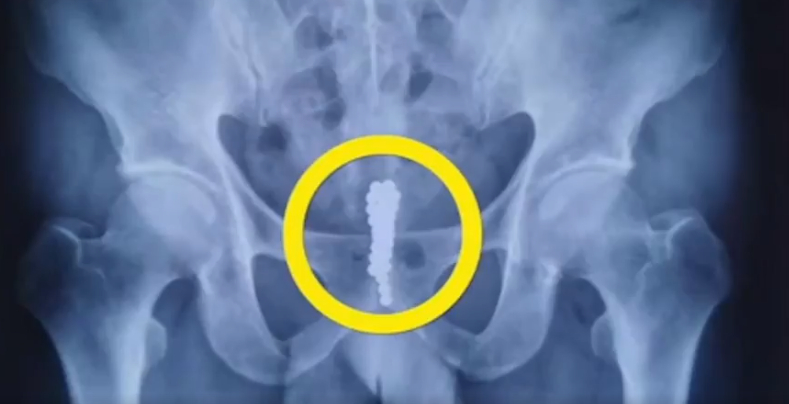 В Китай мъж откри в пениса си верига от магнитни топки