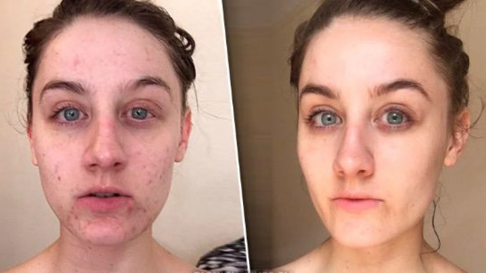 Млада жена не миеше лицето си цяла година и се случи нещо шокиращо СНИМКИ