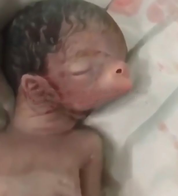Бебе се роди със свинска зурла и уши на врата ВИДЕО