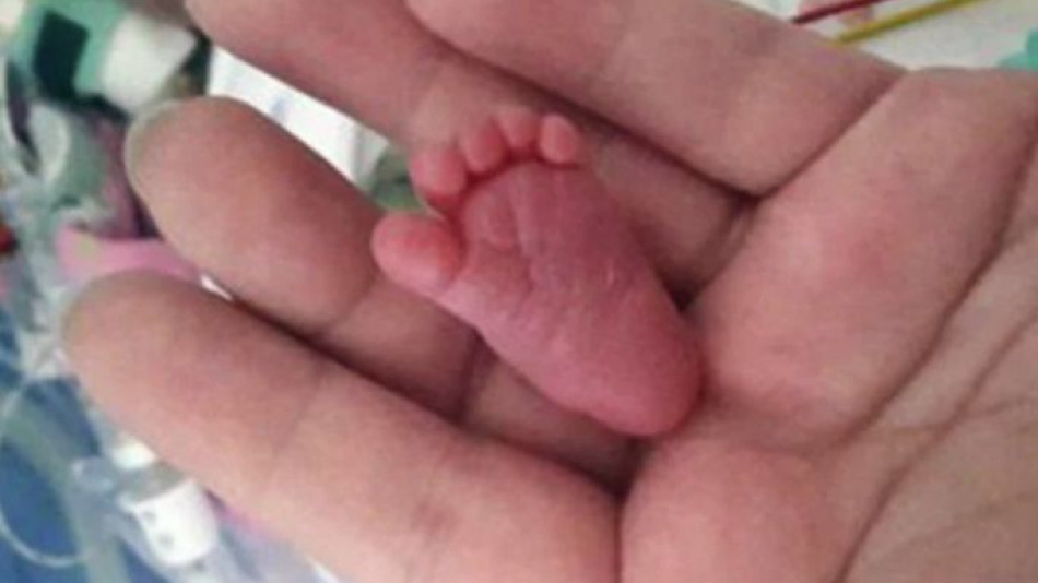 Чудото с малкия борец Емилия, която се роди едва 226 грама, удиви и лекарите  