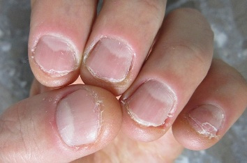 Студентка показа страшната истина за последствията от гризането на ноктите СНИМКА