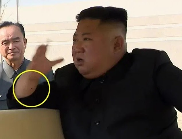 Медици видяха нещо на ръката на Ким Чен Ун и обясниха защо бе изчезнал СНИМКИ