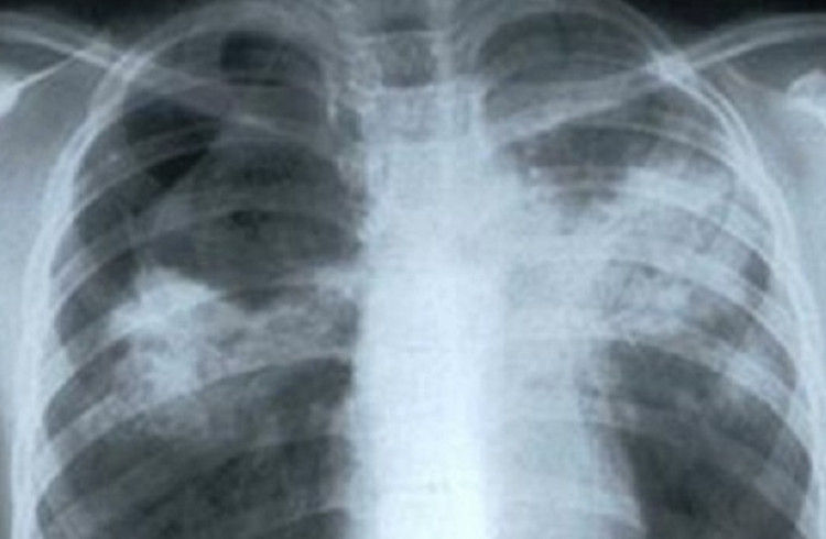 Три външни признака, които сигнализират за раков тумор в белите дробове
