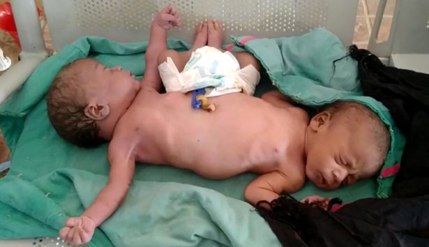 25-годишна роди сиамски близнаци с две ръце и четири крака СНИМКА