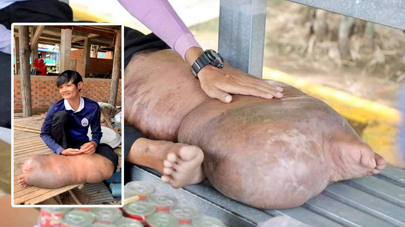 Кошмар: Раздутият крак на младеж е пълен с червеи след ухапване от комар ВИДЕО 