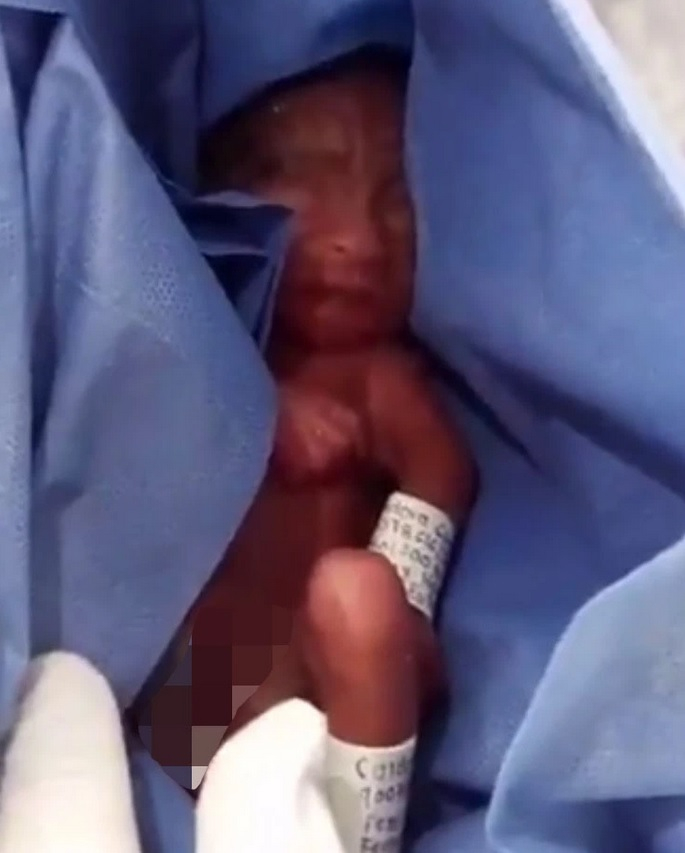 Невиждано чудо! Родено в шестия месец бебе оцеля след 6 часа в моргата