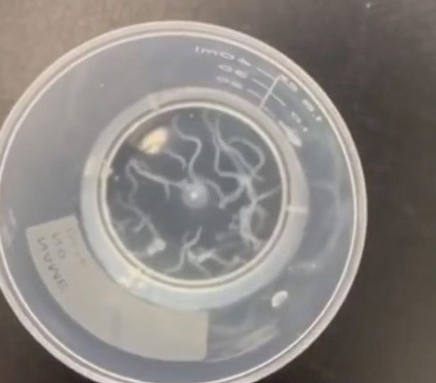 Лекар извади 20 живи червеи от окото на пациент! ВИДЕО 18+