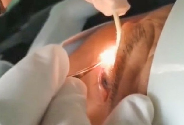 Лекар извади 20 живи червеи от окото на пациент! ВИДЕО 18+