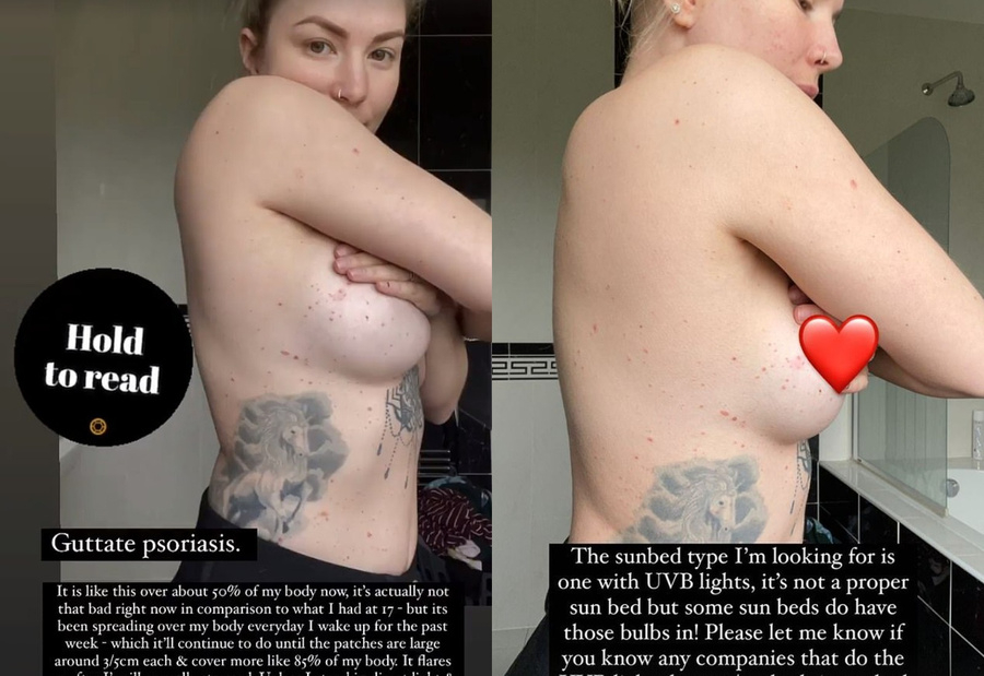 Блогърка се снима топлес, за да покаже как болест е променила тялото й СНИМКИ 18+
