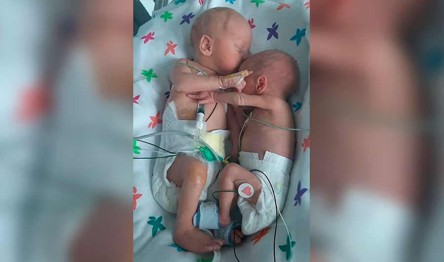 Трогателно: Оцеляла по чудо сестра нежно прегръща своя брат близнак в кувьоза СНИМКИ