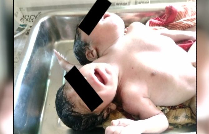 Бебе с две глави и три ръце ококори лекарите СНИМКА