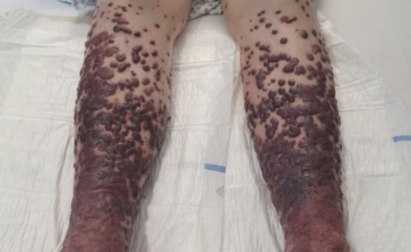 Жена се ваксинира с "АстраЗенека" и се покри с ужасяващи мехури СНИМКИ 18+