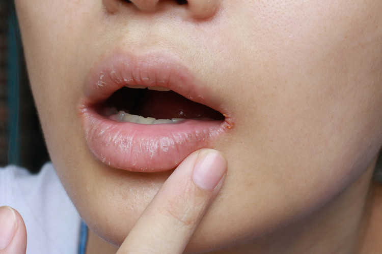 Напуканите устни вещаят опасности за здравето