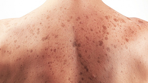 7 признака за рак на кожата, на които никой не обръща внимание