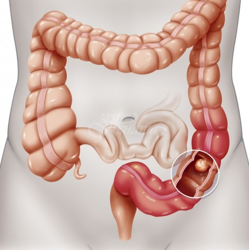 Колопроктолог изброи първите признаци за рак на дебелото черво