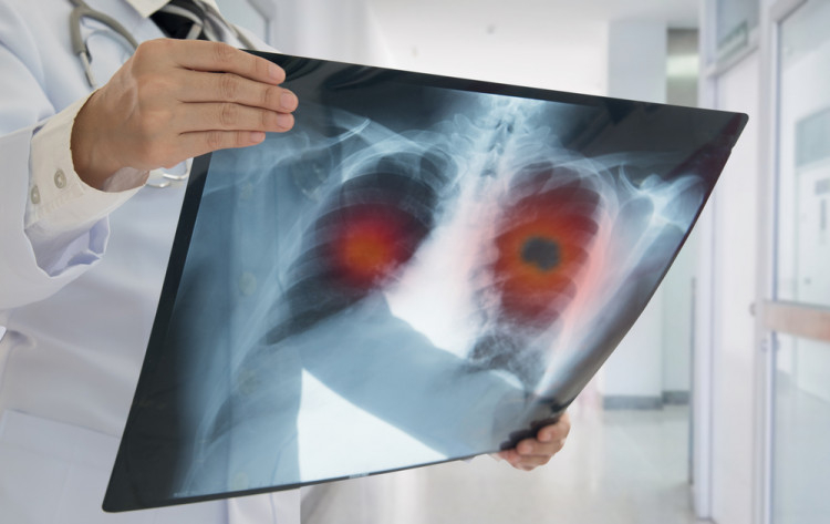 Какви са симптомите на рака на белия дроб?