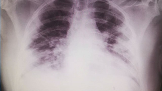 Лекар от ИСУЛ показа страшна СНИМКА на белите дробове на починалия 27-г мъж с фалшив сертификат