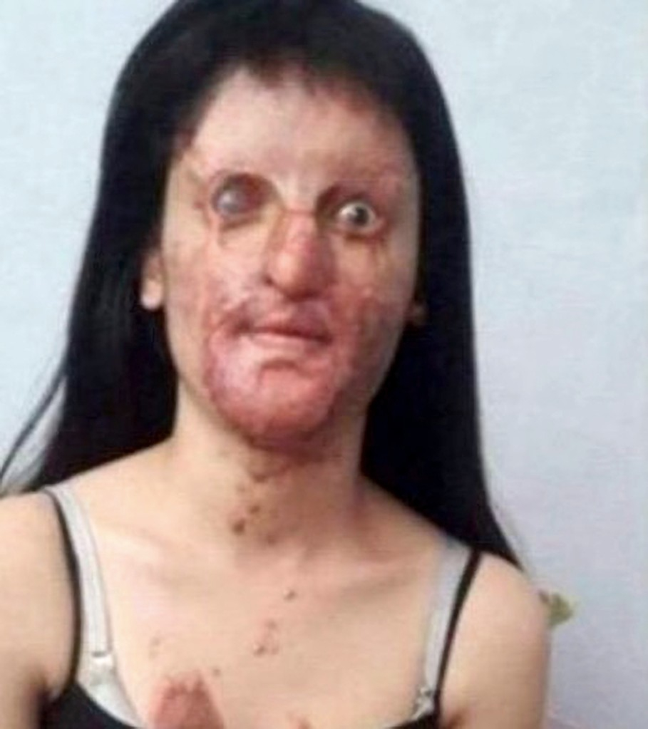 Момиче се омъжи за изверга, който обезобрази лицето й, заливайки го с киселина СНИМКИ 
