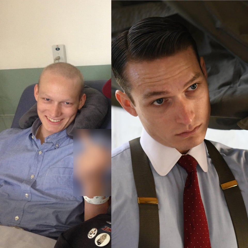 Оцелели от рак показват как са изглеждали по време на химиотерапията СНИМКИ