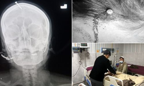 Бременна пакистанка заби пирон в главата си, искала да зачене мъжка рожба СНИМКИ