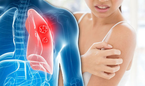 Експерт описа кожните симптоми при рак на белите дробове
