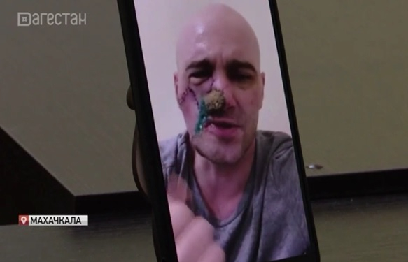 Руски войник изгуби лицето си в Украйна, но спаси другарите си от смърт ВИДЕО 18+