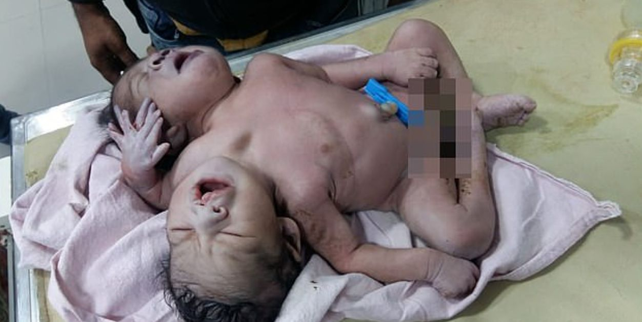 Пълен шок! Индийка роди двуглаво бебе с три ръце и... ВИДЕО 