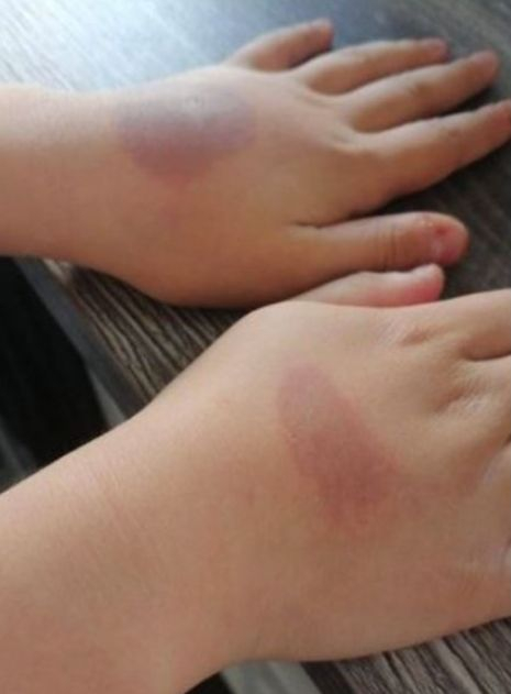 10-г. момиченце пострада след опасно TikTok предизвикателство 