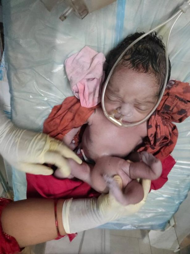 Бебе с четири ръце и четири крака подлуди Индия СНИМКИ 