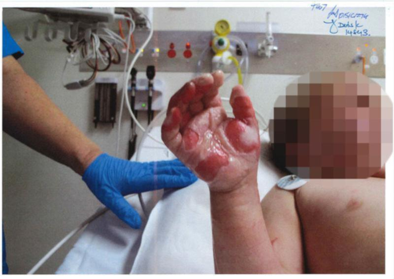 Потресаващо: Изверг свари ръцете на 2 годишно момиченце, оправдава се, че...  СНИМКИ 18+