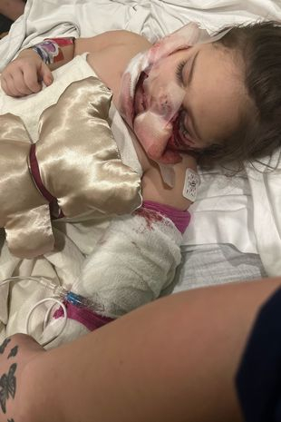 Ужас! Питбул разкъса лицето на 3-годишно момиченце СНИМКИ 18+