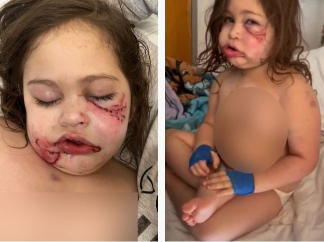 Ужас! Питбул разкъса лицето на 3-годишно момиченце СНИМКИ 18+